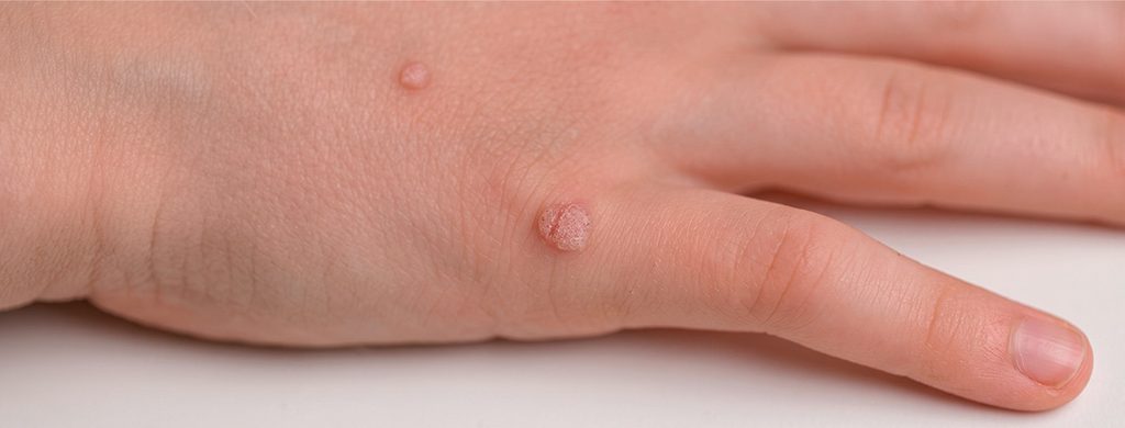 El virus de VPH se clasifica en alto riesgo y bajo riesgo.