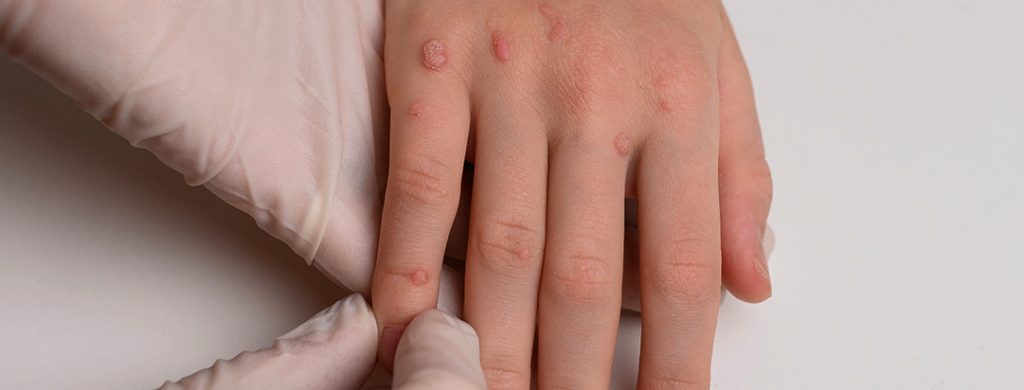 Las lesiones por VPH de bajo riesgo aparecen como verrugas sobre la piel